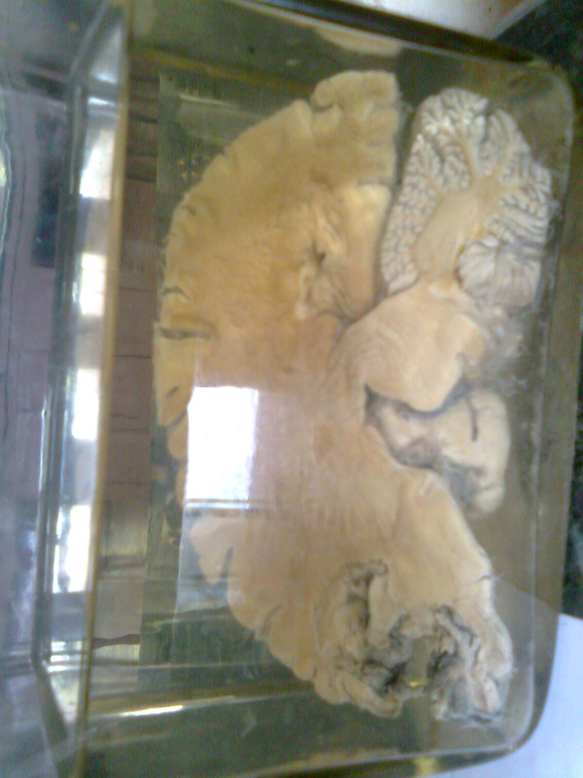 Brain abscess