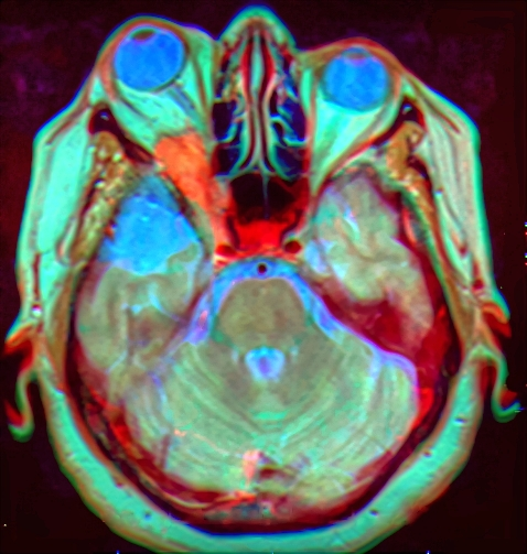 Brain tumor