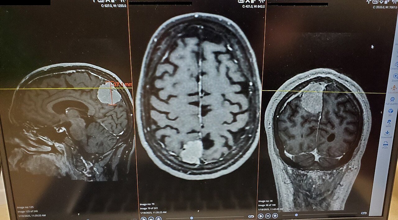 Brain tumor