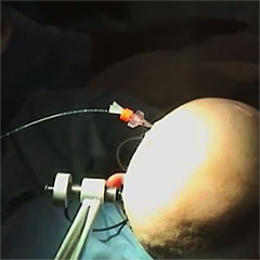 Brain tumor