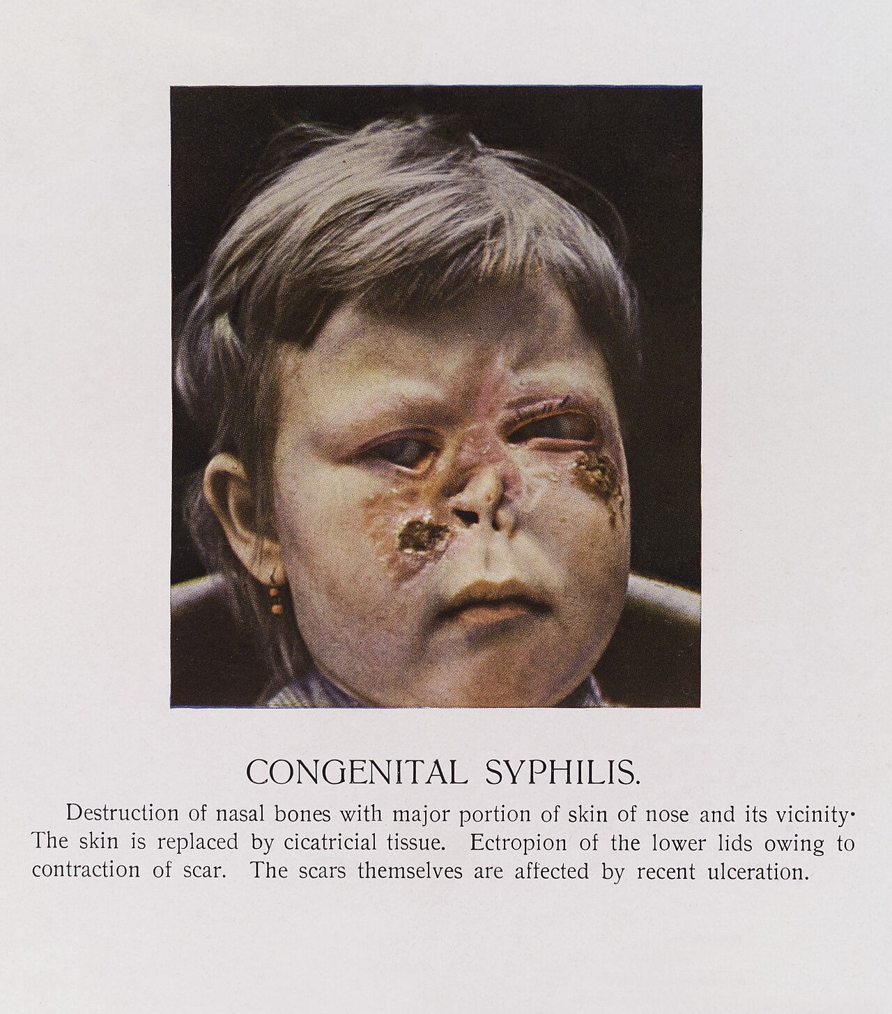 Congenital syphilis
