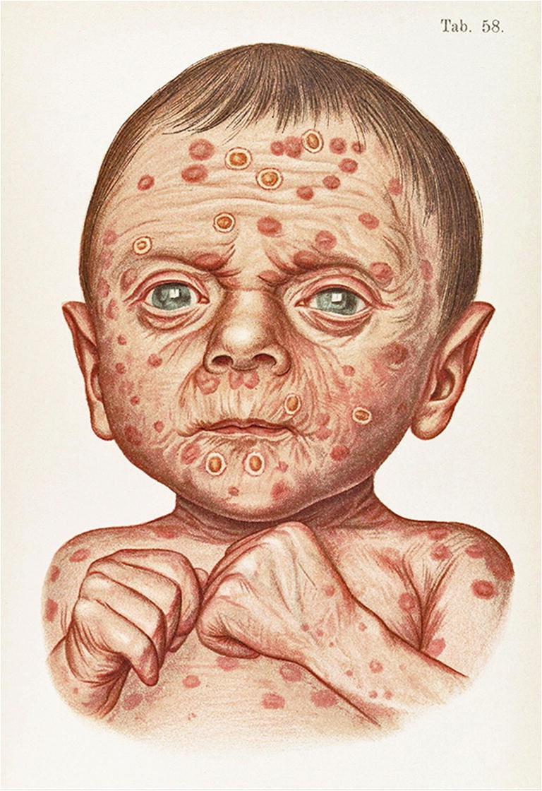 Congenital syphilis