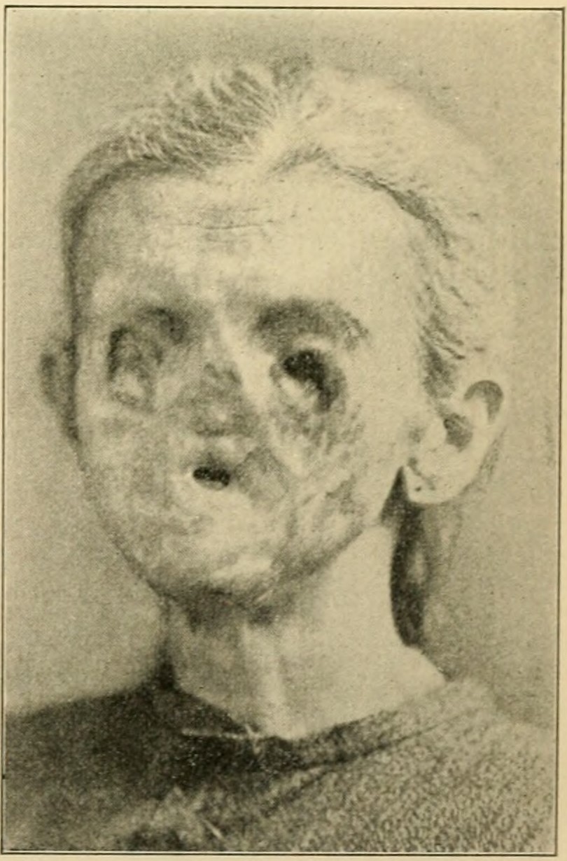 Congenital syphilis