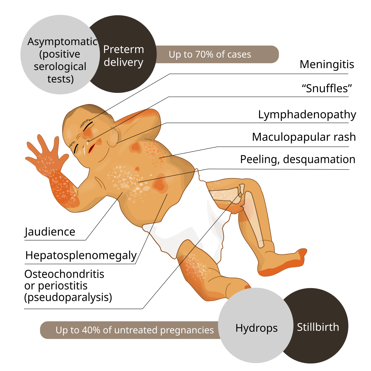 Congenital syphilis