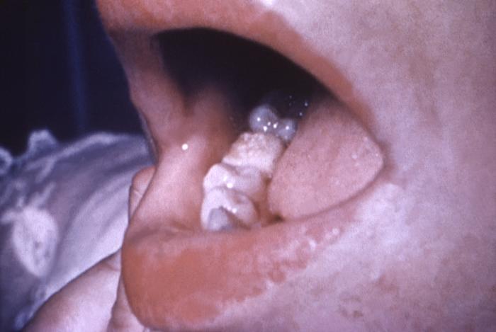 Congenital syphilis