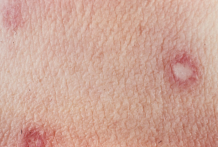 Degos disease