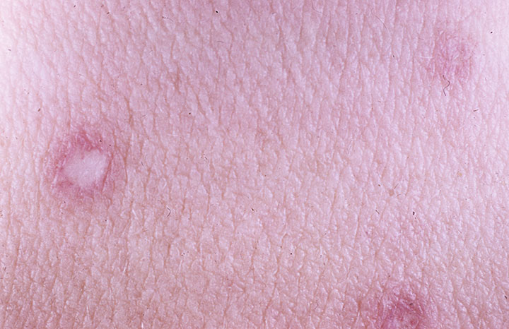 Degos disease