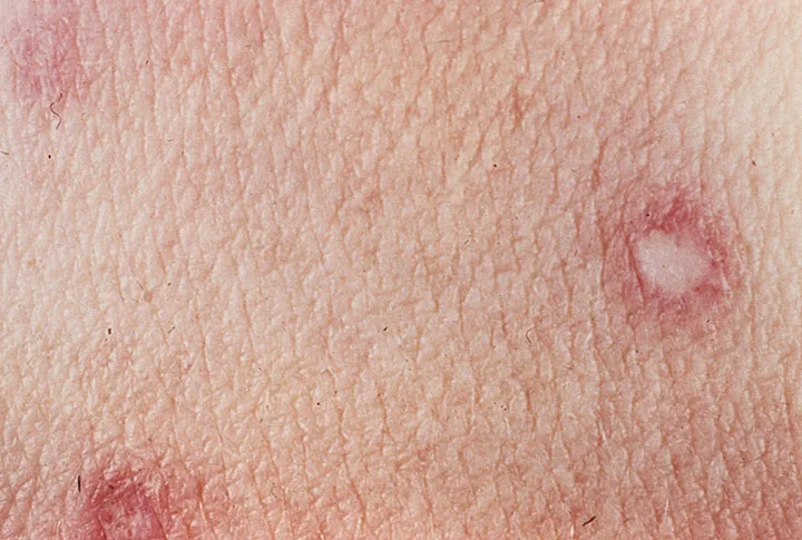 Degos disease