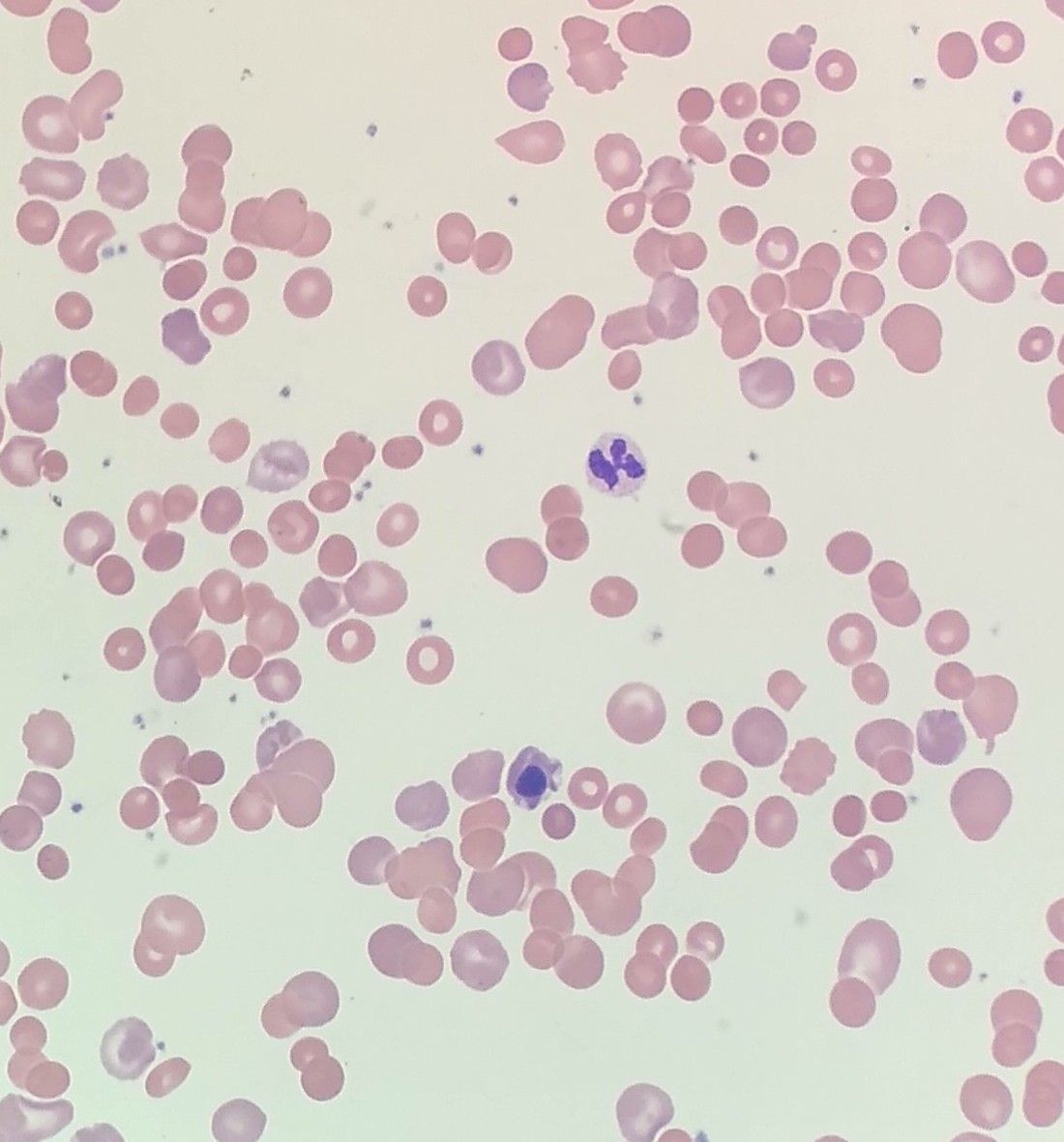 Drug-induced autoimmune hemolytic anemia