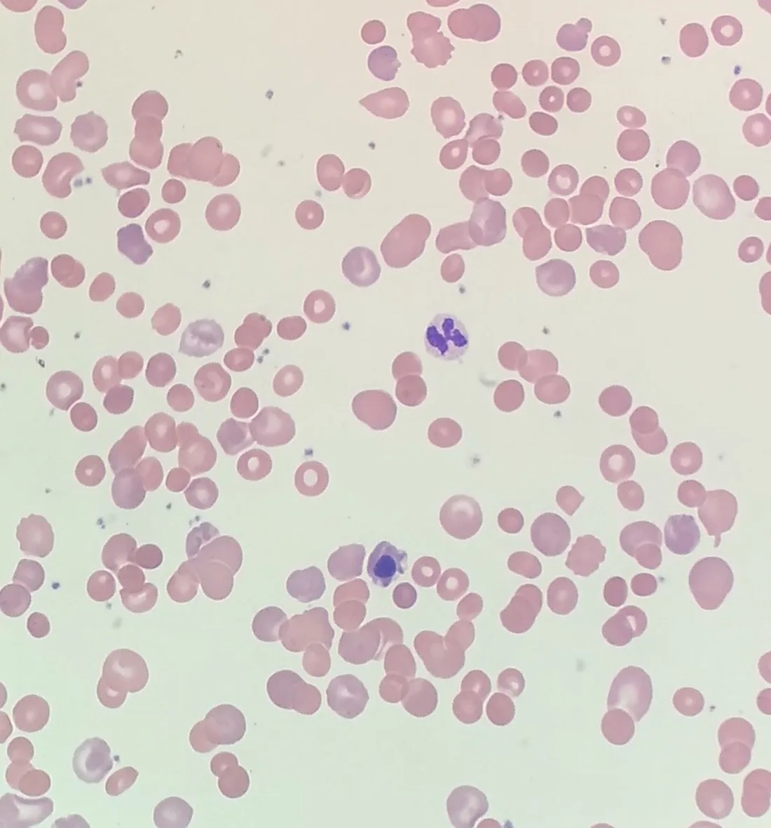 Drug-induced autoimmune hemolytic anemia