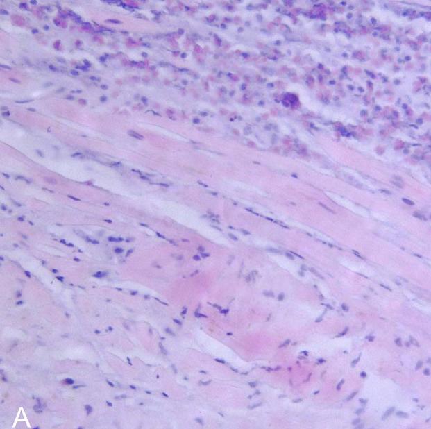 Eosinophilic myocarditis