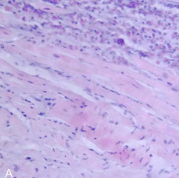 Eosinophilic myocarditis