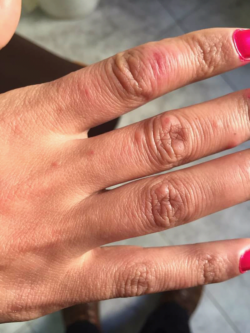 Chilblains