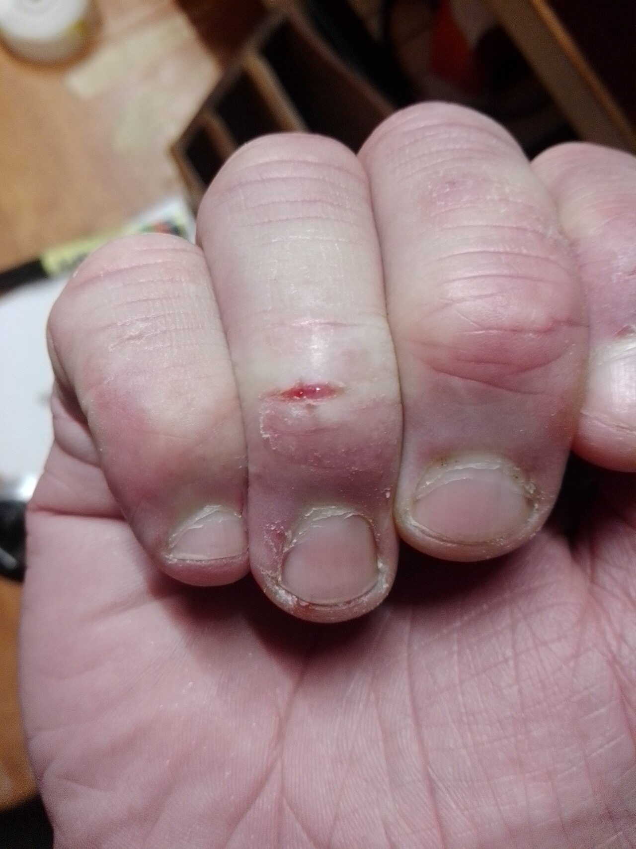 Chilblains