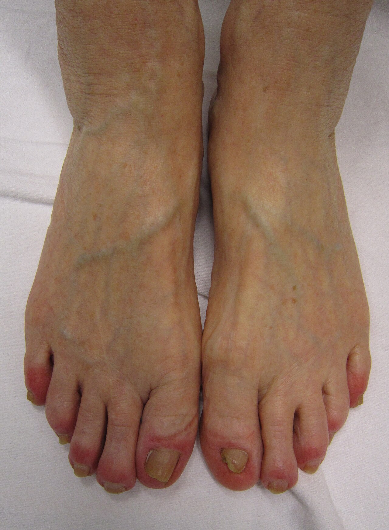Chilblains