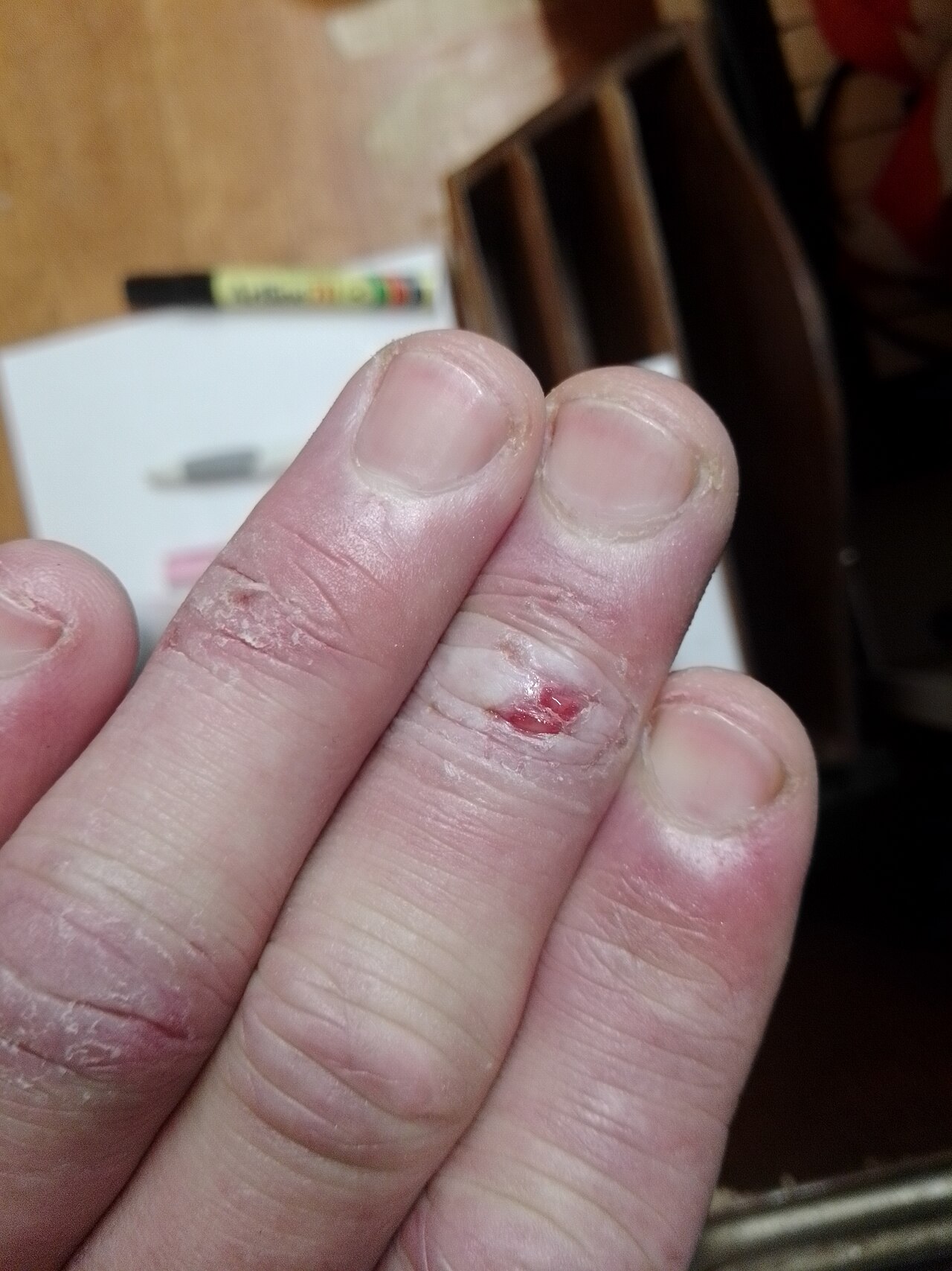 Chilblains
