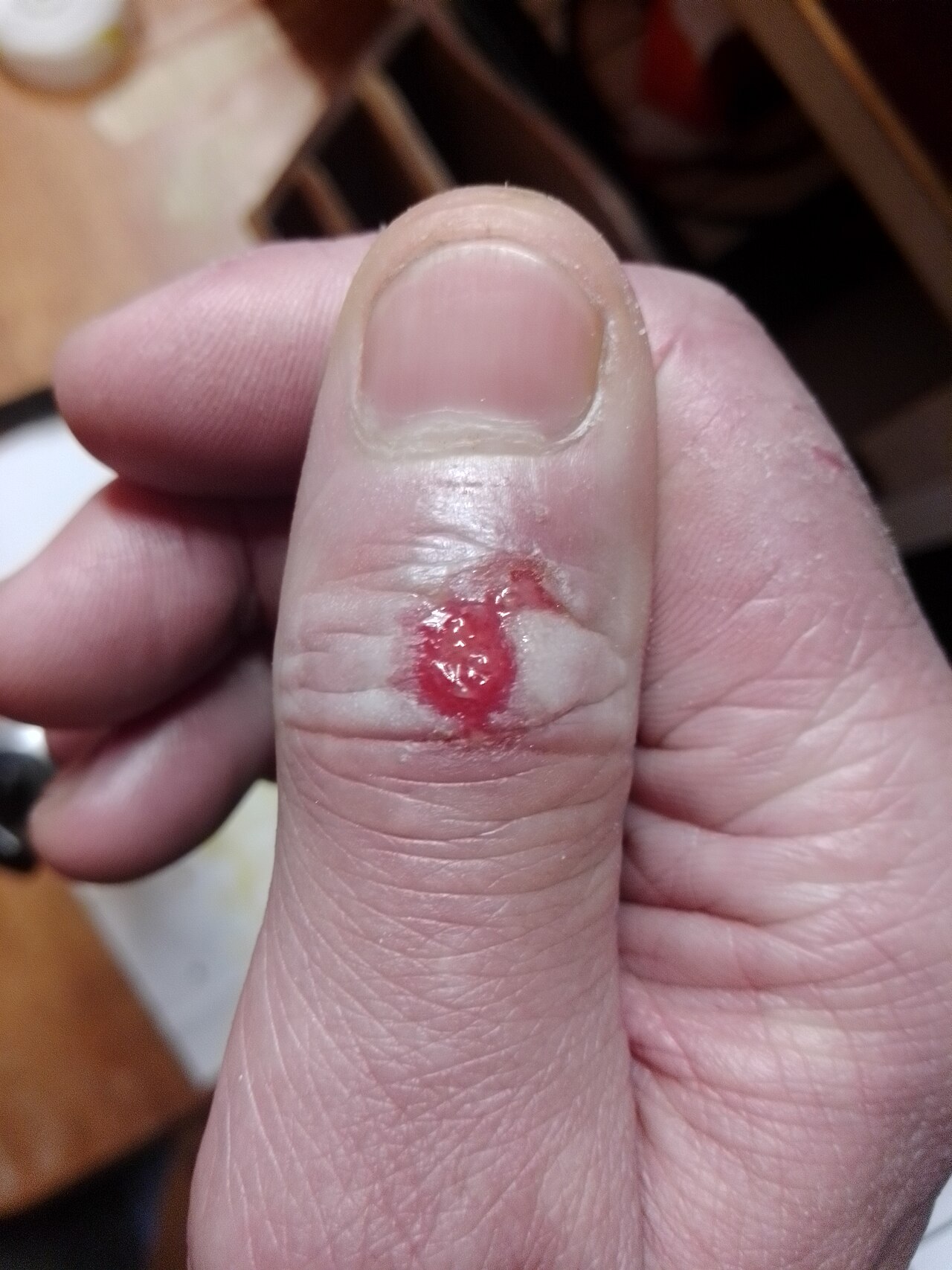Chilblains
