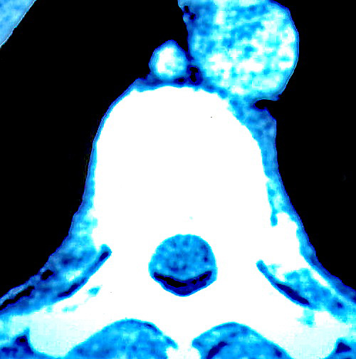Decompression sickness