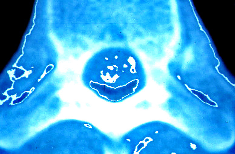 Decompression sickness