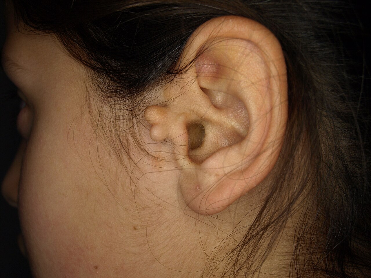 Accessory auricle