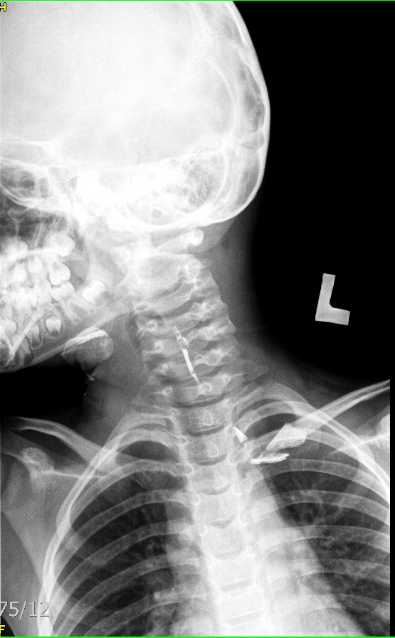 Branchial cleft cyst