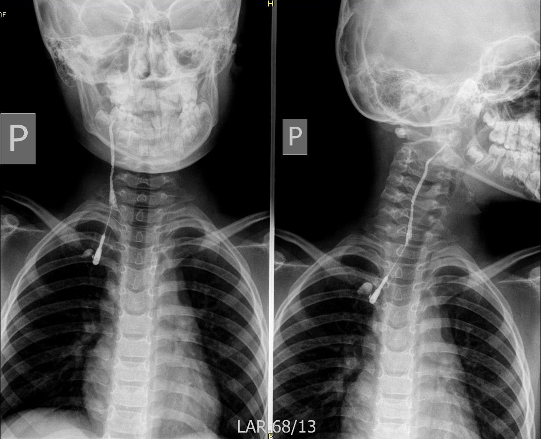 Branchial cleft cyst