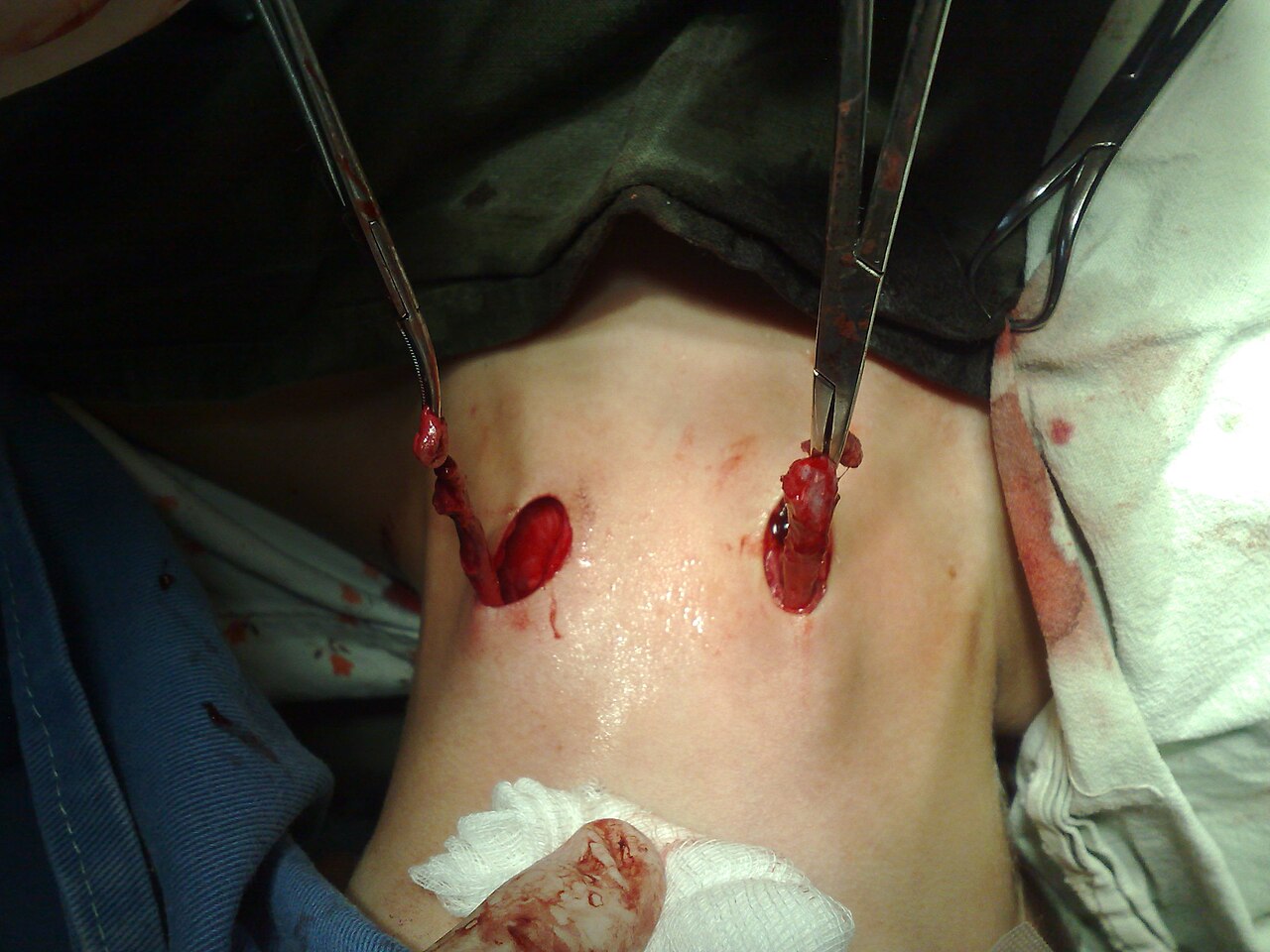 Branchial cleft cyst