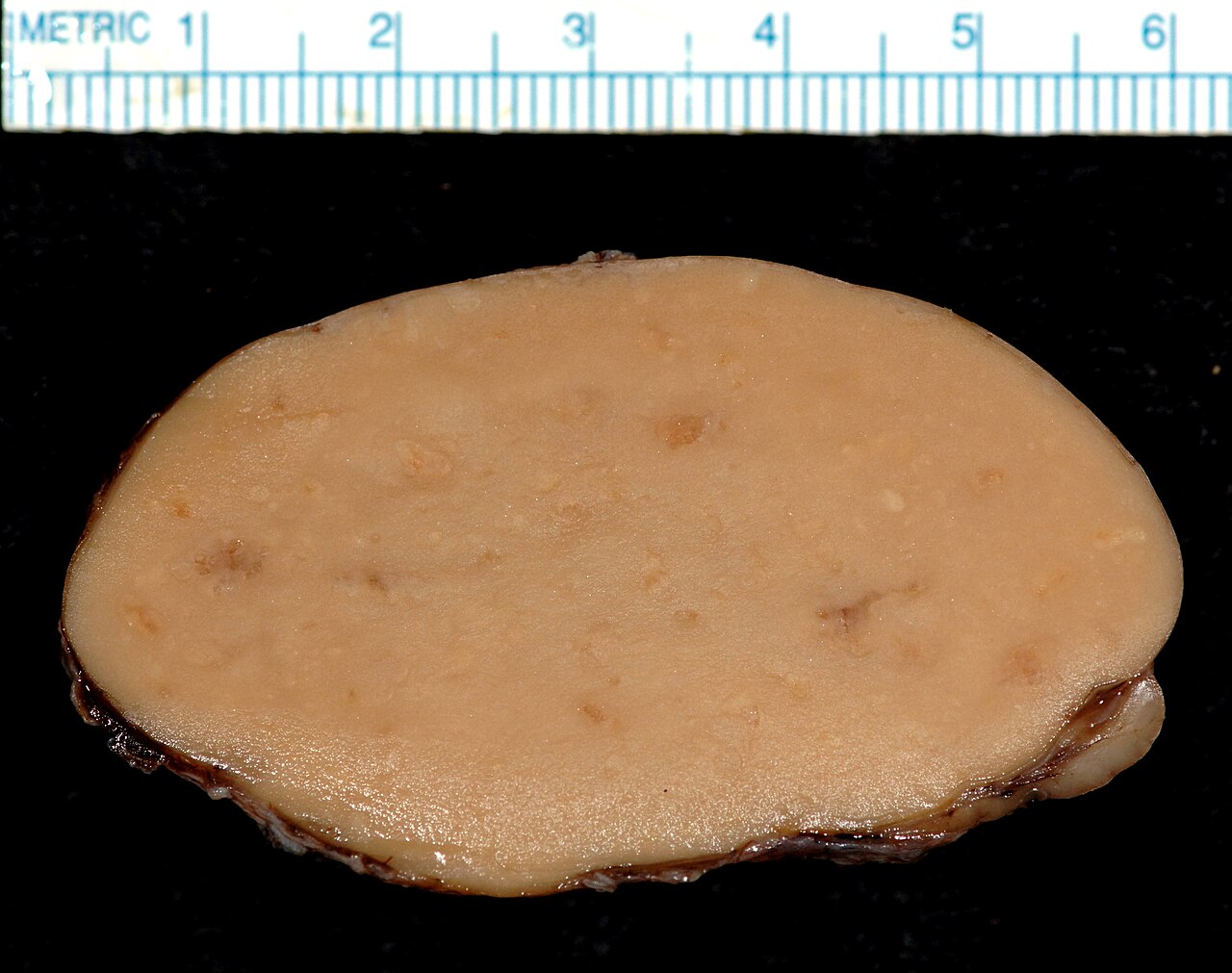 Branchial cleft cyst