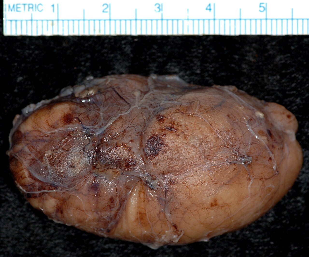 Branchial cleft cyst