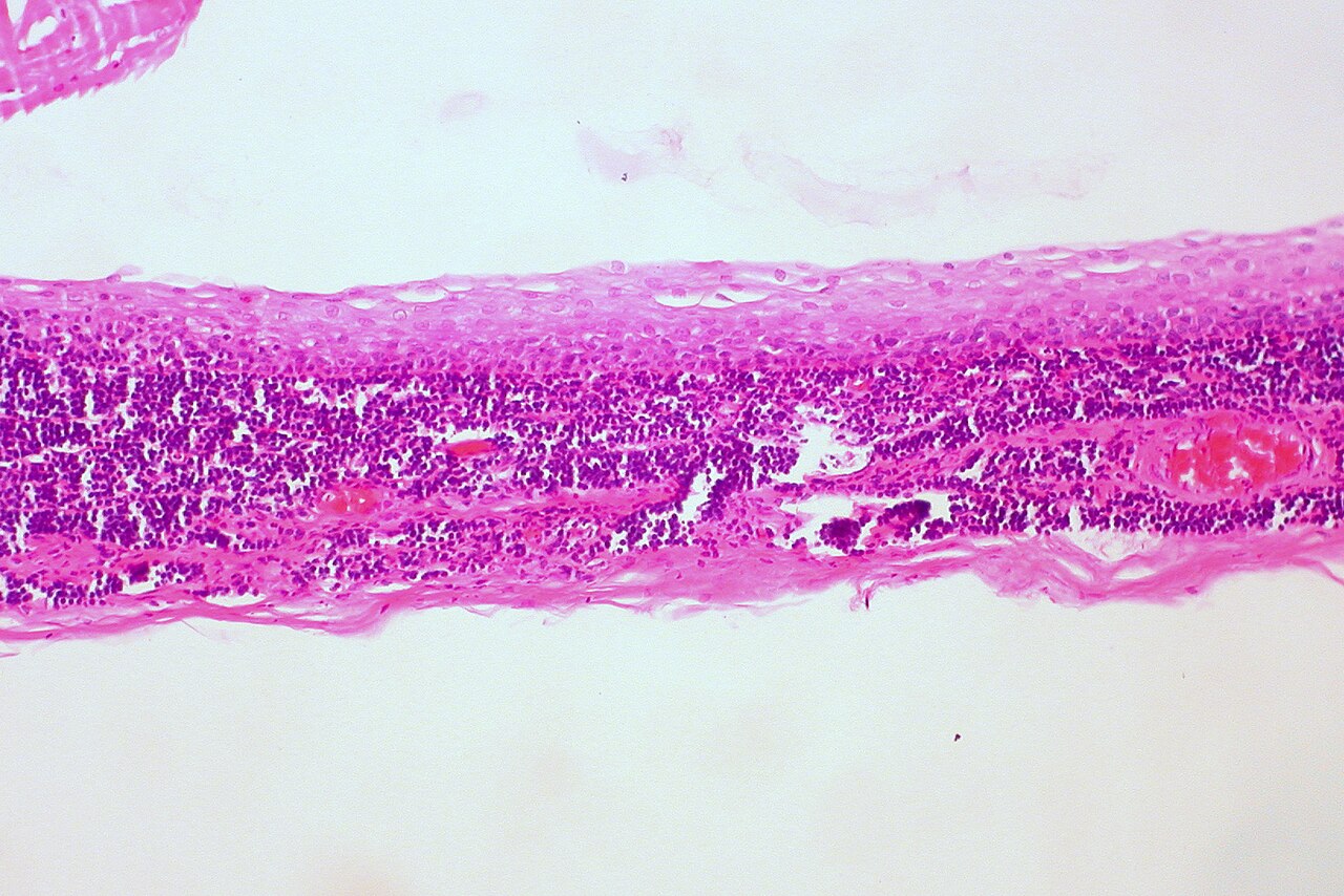 Branchial cleft cyst