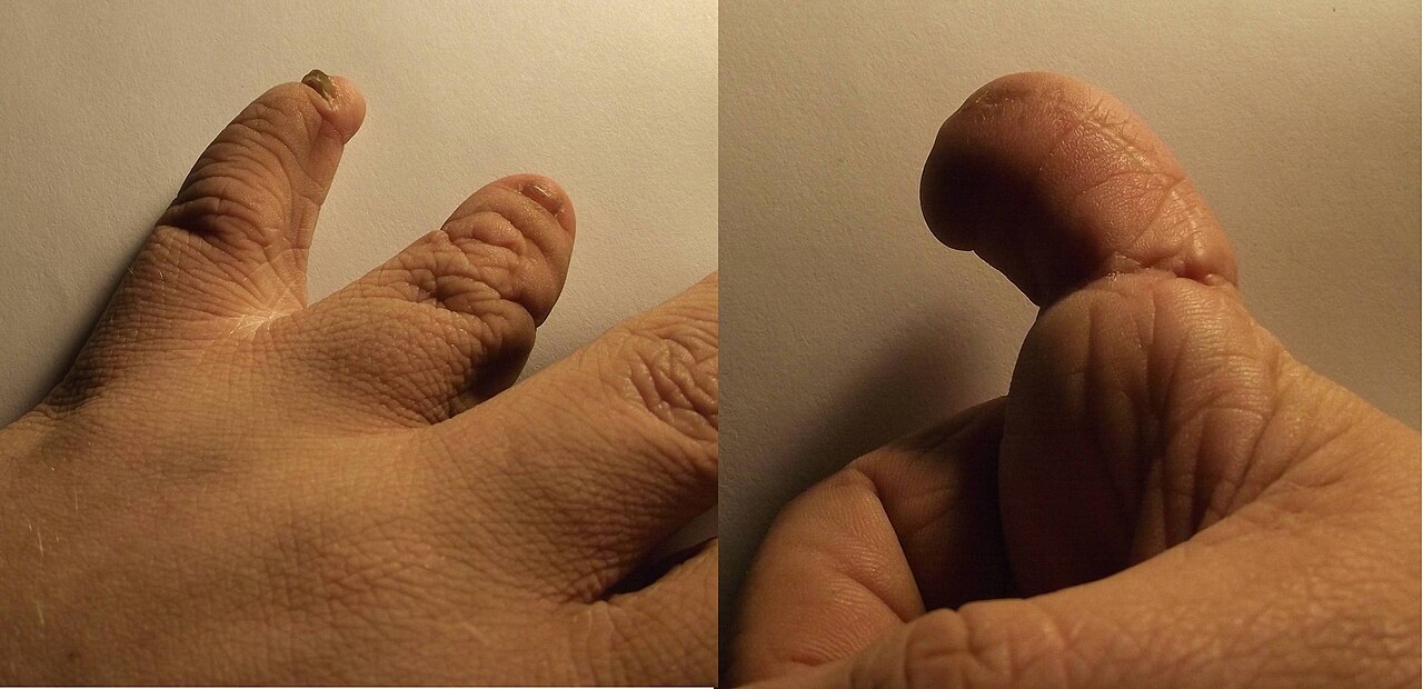 Constriction ring syndrome