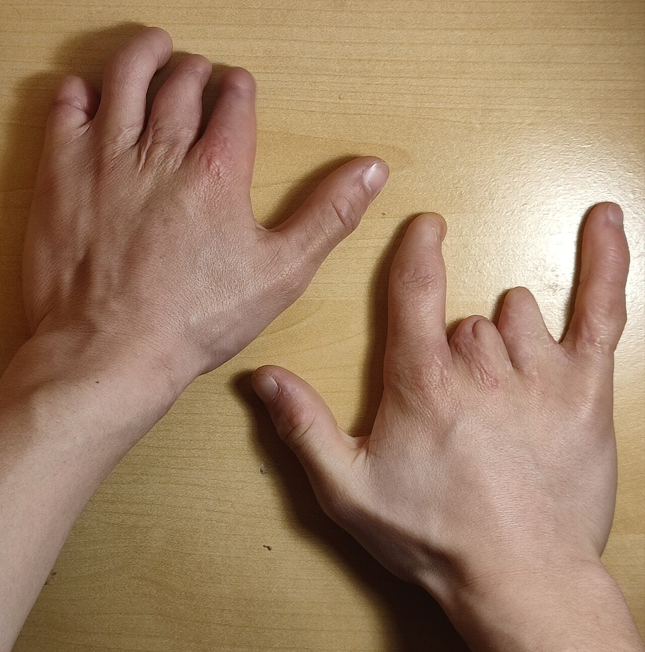 Constriction ring syndrome