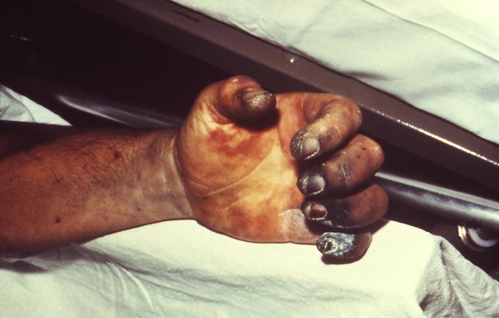 Hand necrosis caused by plague