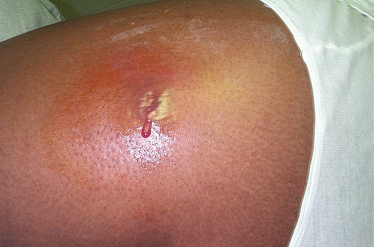 Staphylococcus aureus
