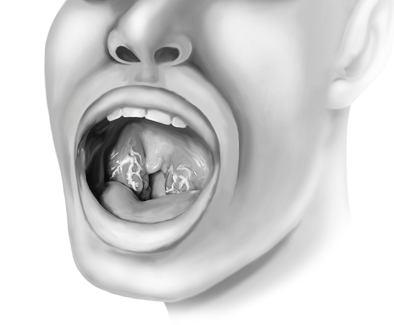 Streptococcus pyogenes