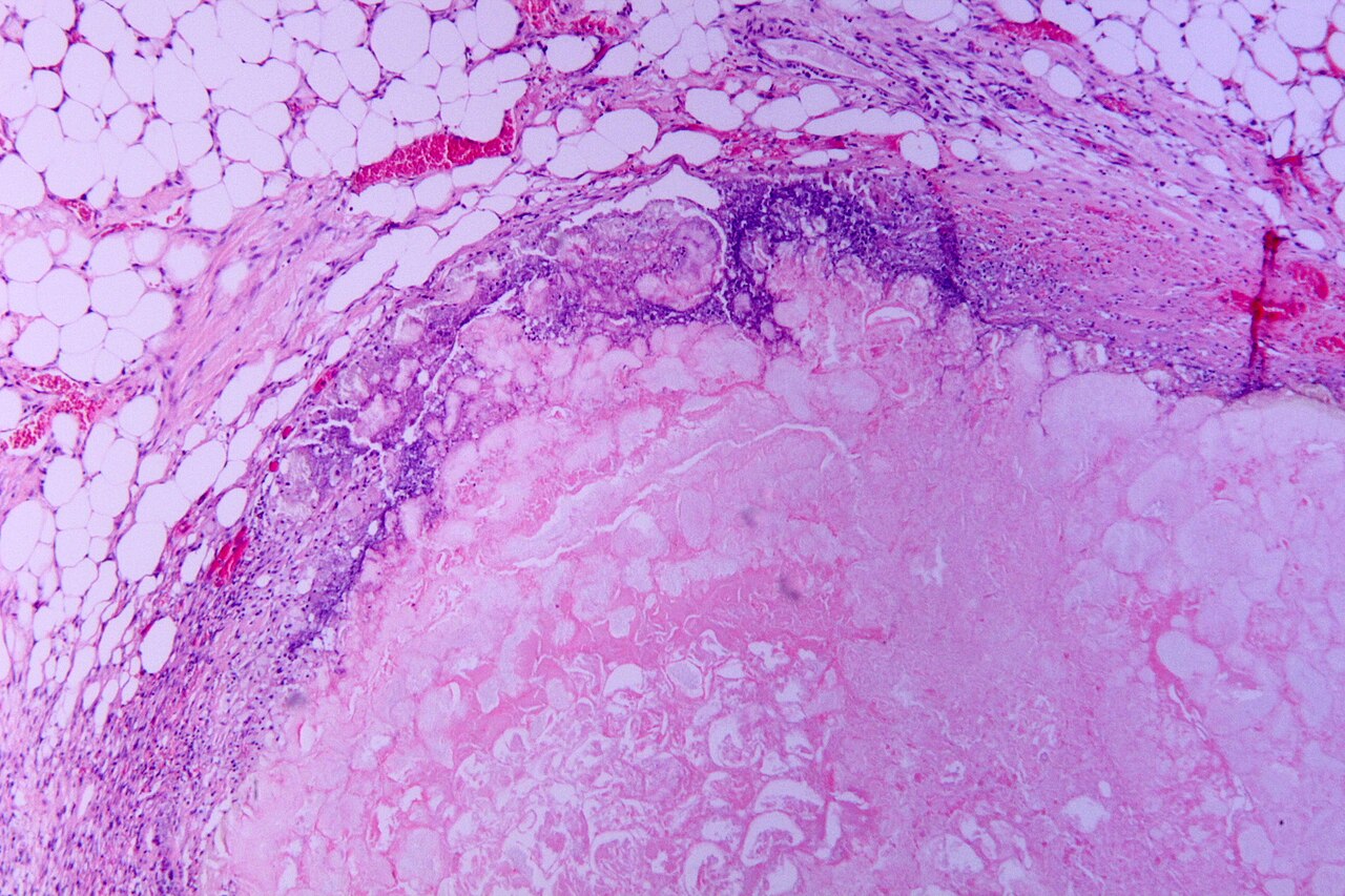 Acute pancreatitis