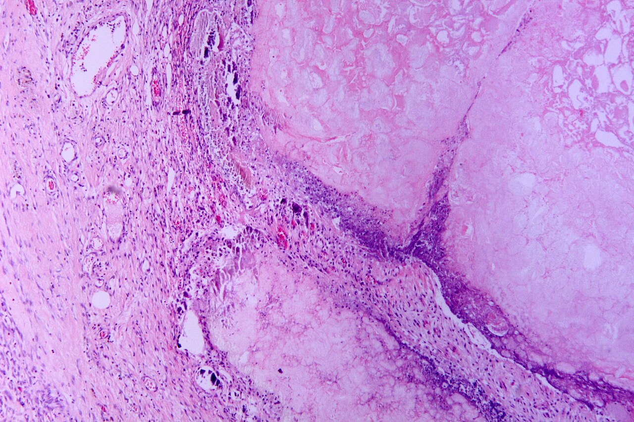 Acute pancreatitis