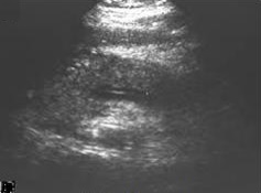 Acute pancreatitis