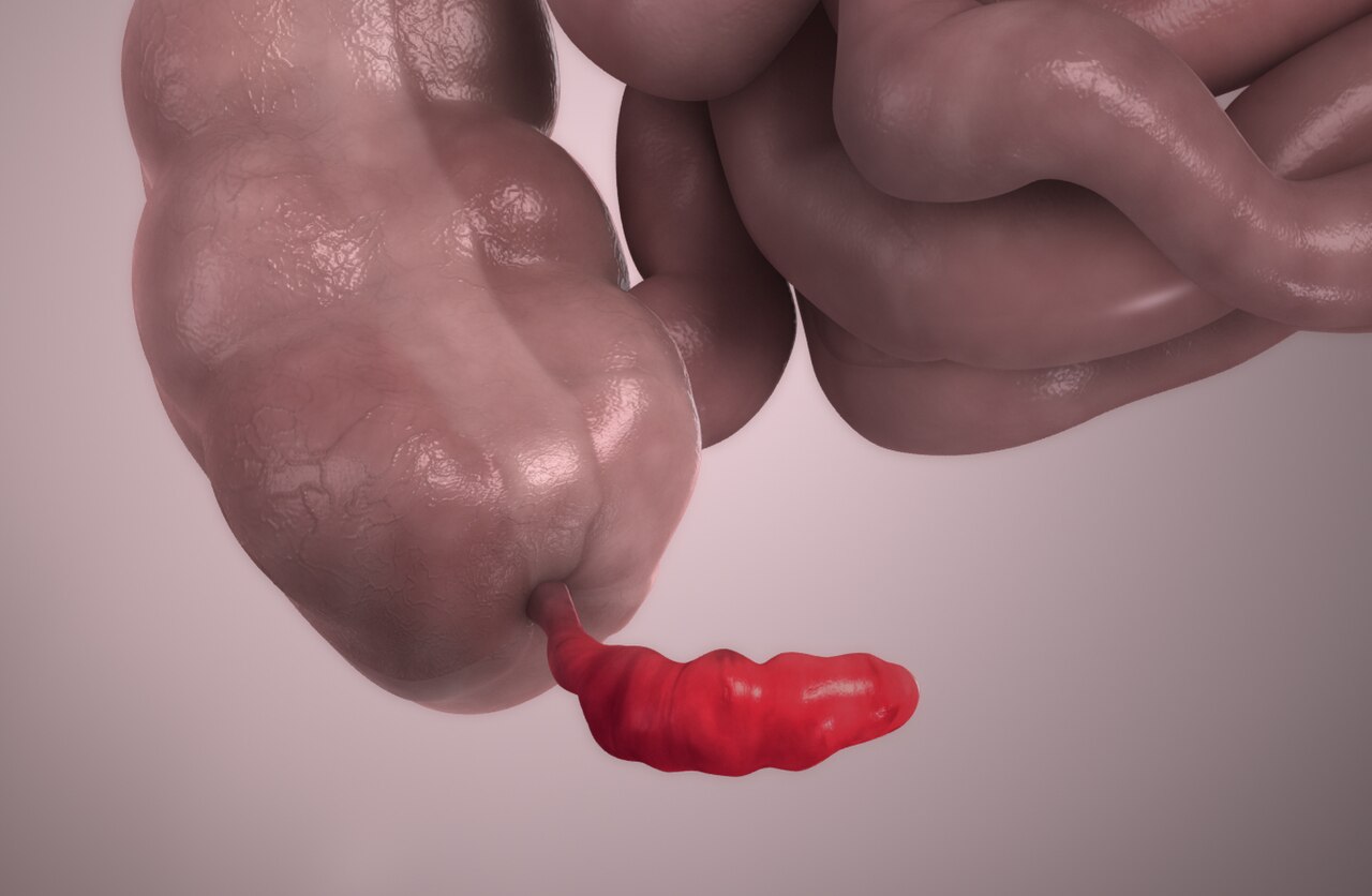 Appendicitis