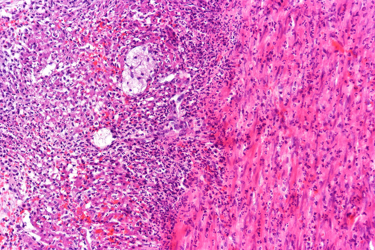 Appendicitis