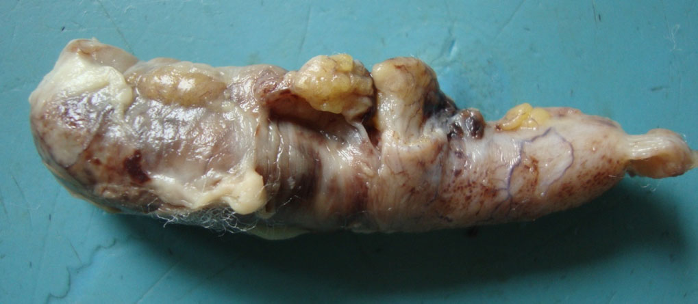 Appendicitis
