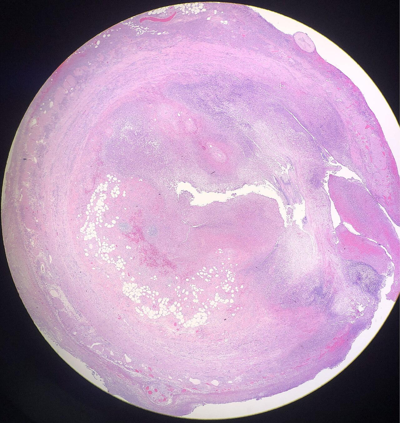 Appendicitis