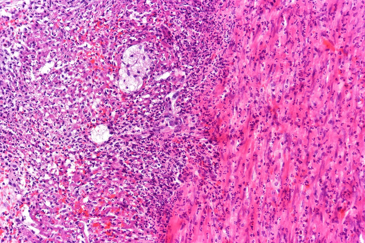 Appendicitis
