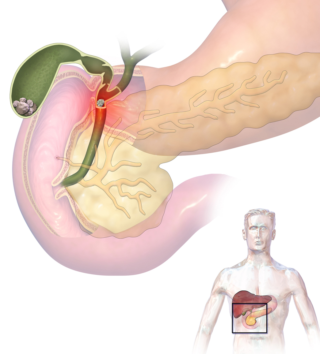 Ascending cholangitis
