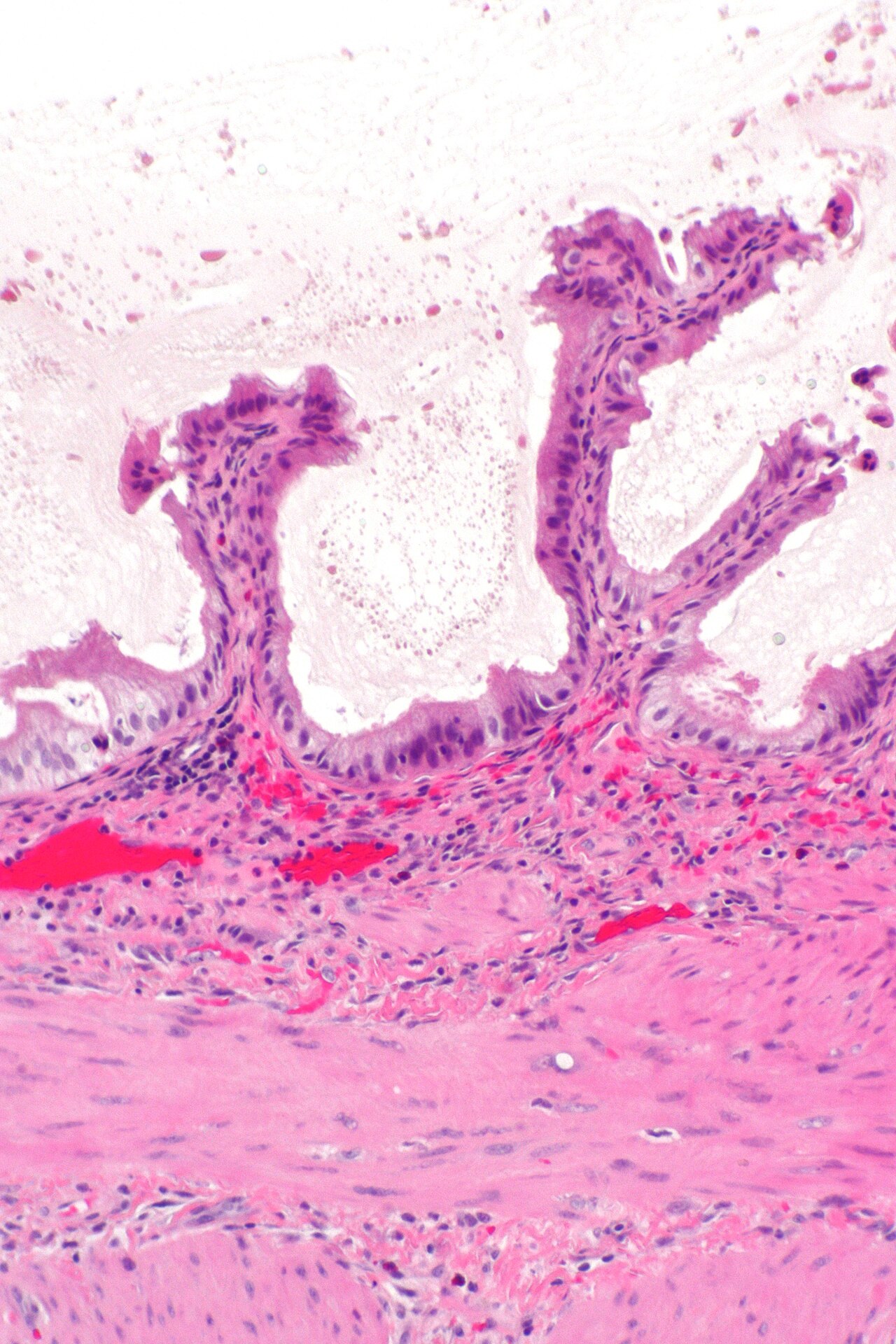 Cholecystitis