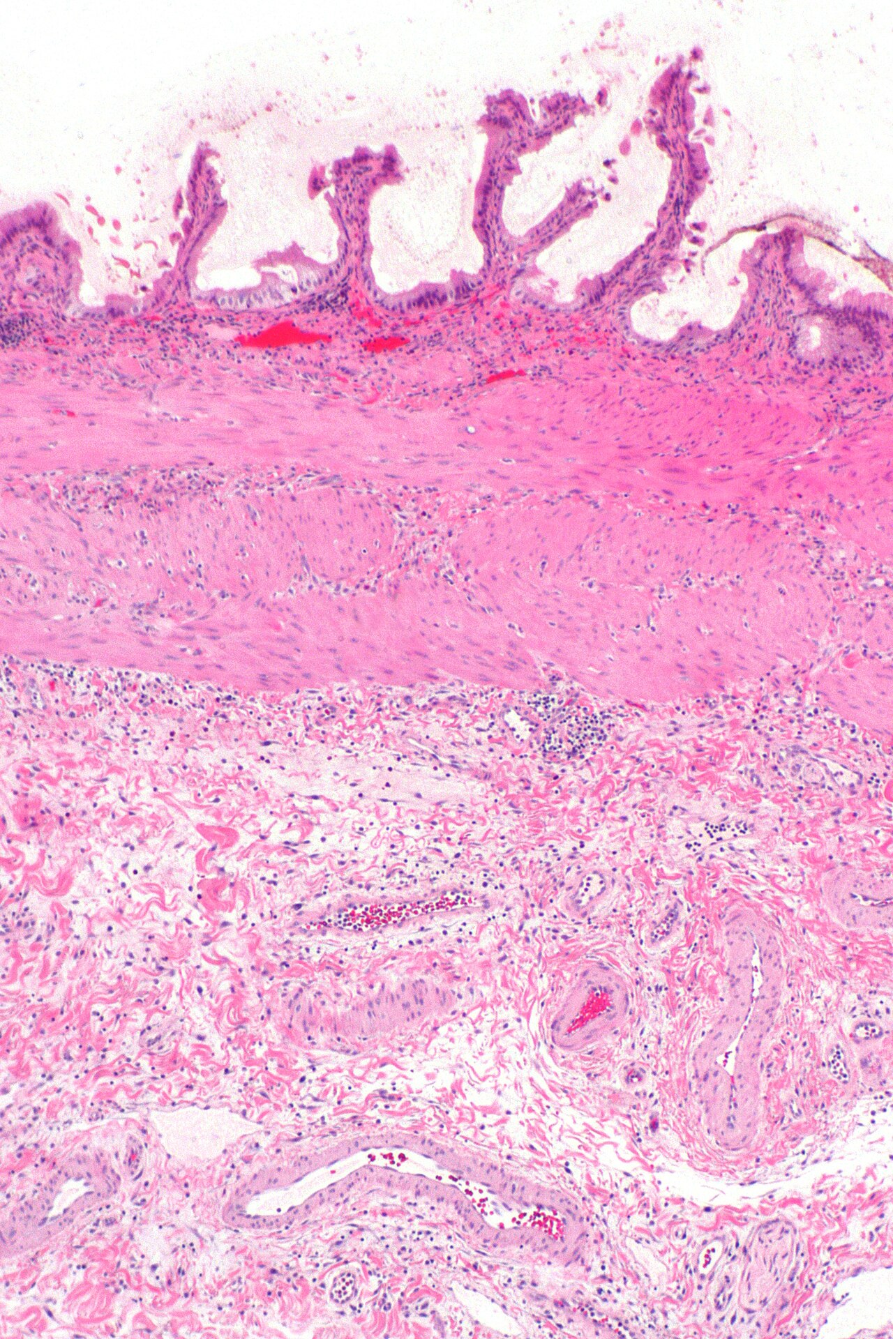 Cholecystitis