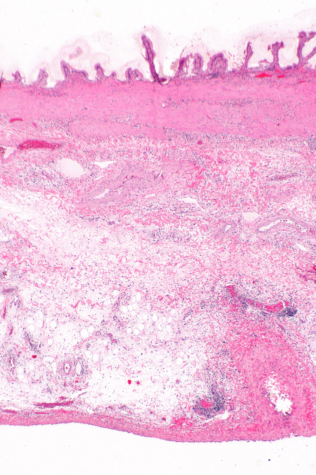 Cholecystitis