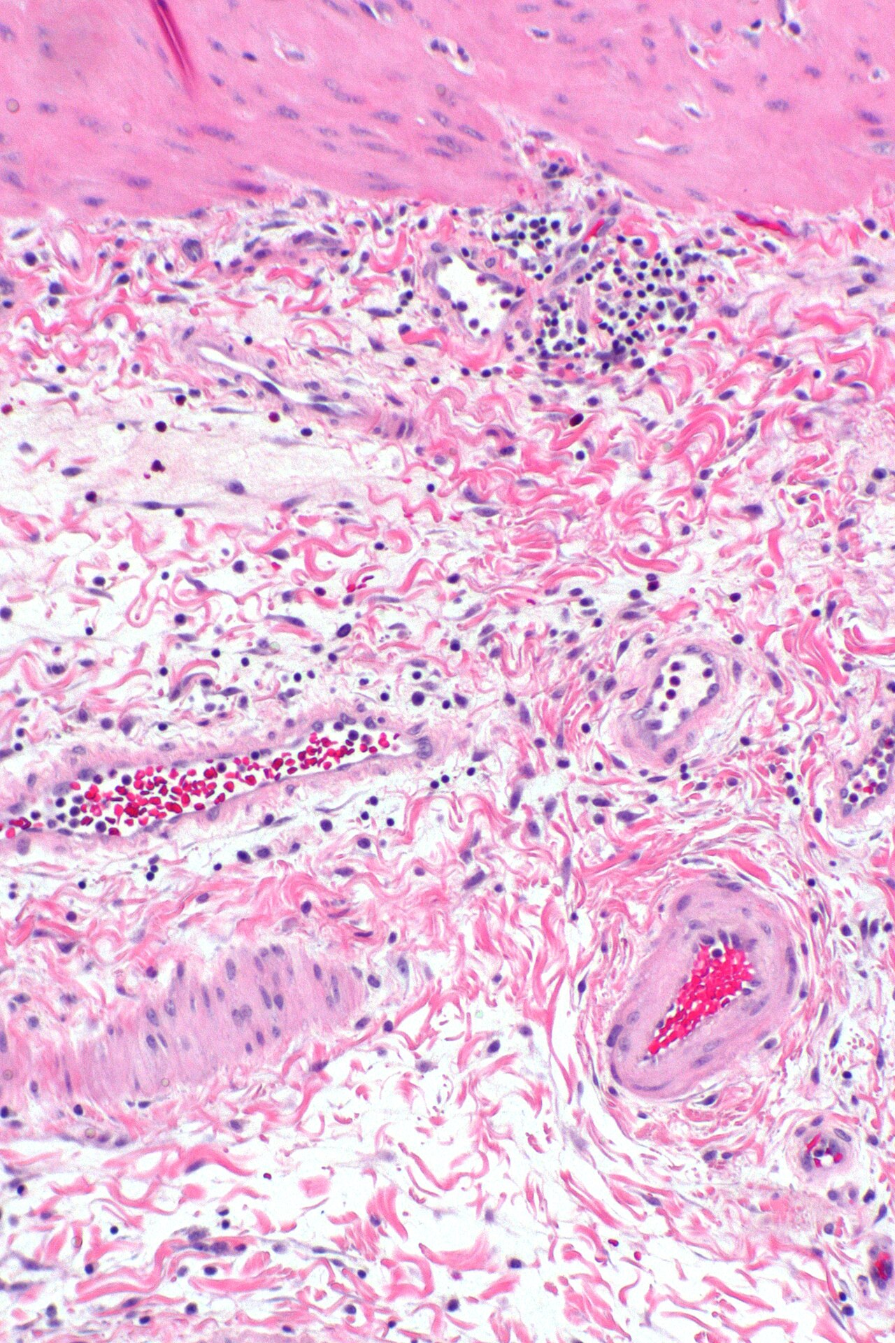 Cholecystitis