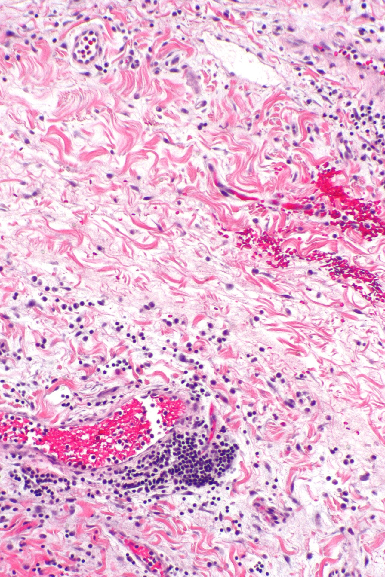 Cholecystitis