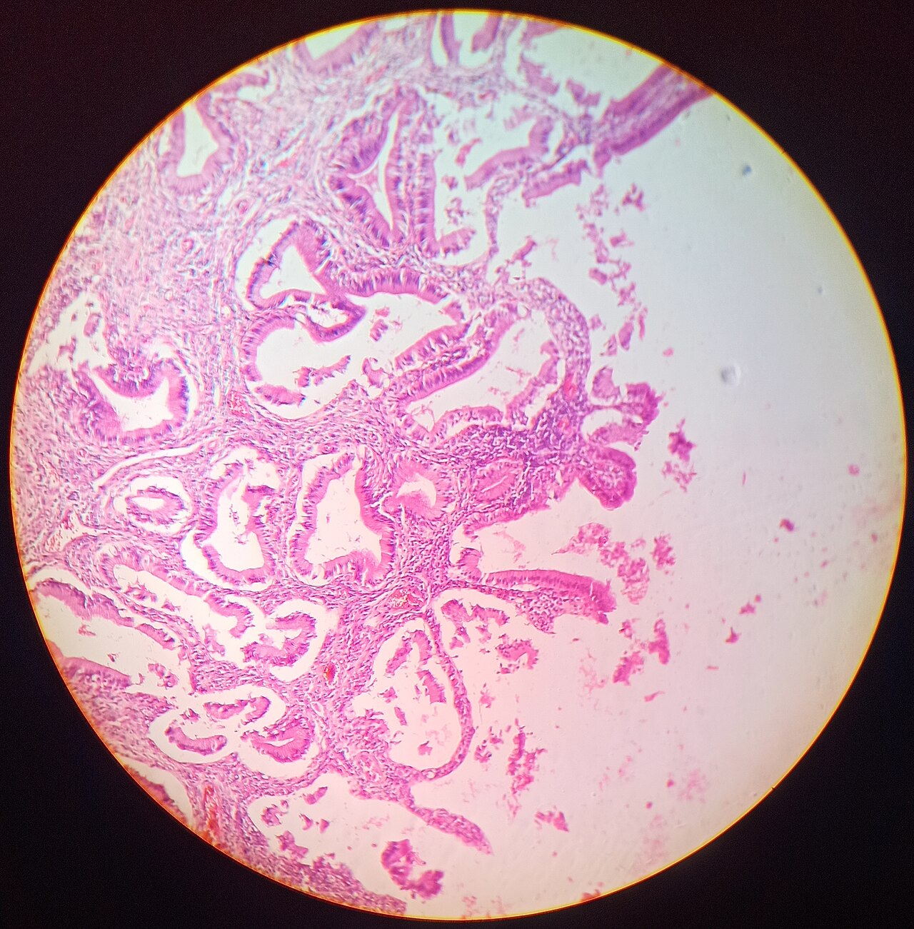 Cholecystitis